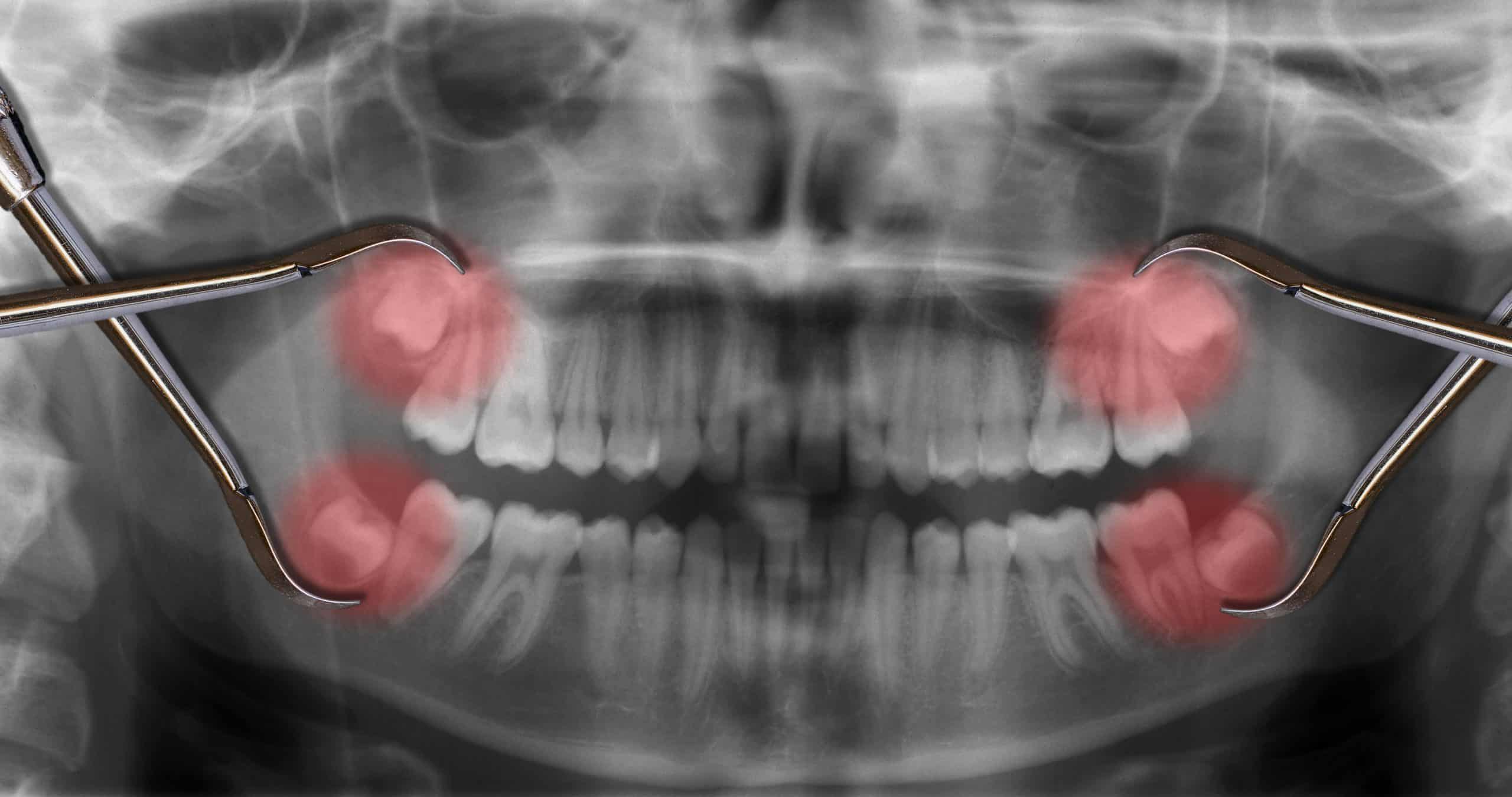 xray showing wisdom teeth