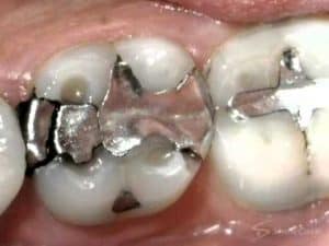 mercury filling removal lower molar with a broken amalgam filling