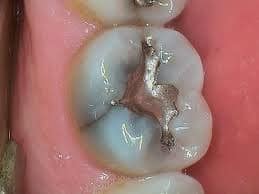 mercury filling removal lower tooth showing amalgam filling and crack