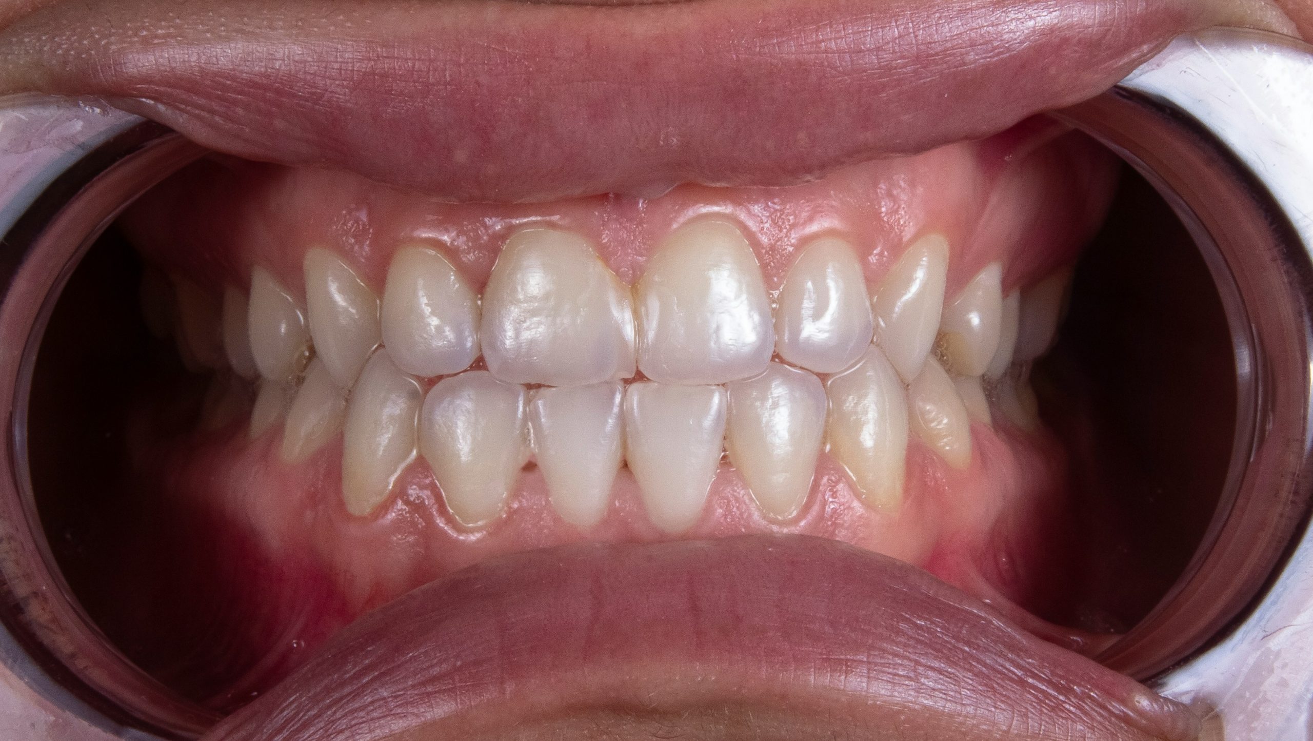 A front view of teeth that have been whitened.