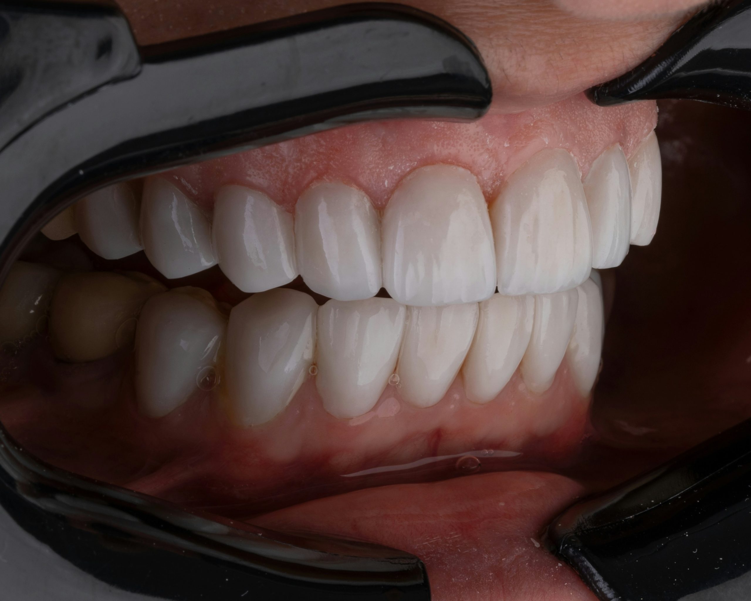 Top and bottom teeth with the lips retracted and a black background.