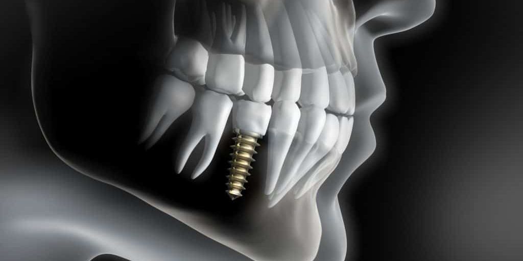 dental implant