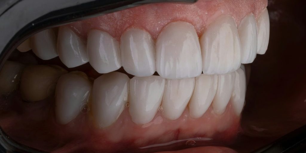 Top and bottom teeth with the lips retracted and a black background.