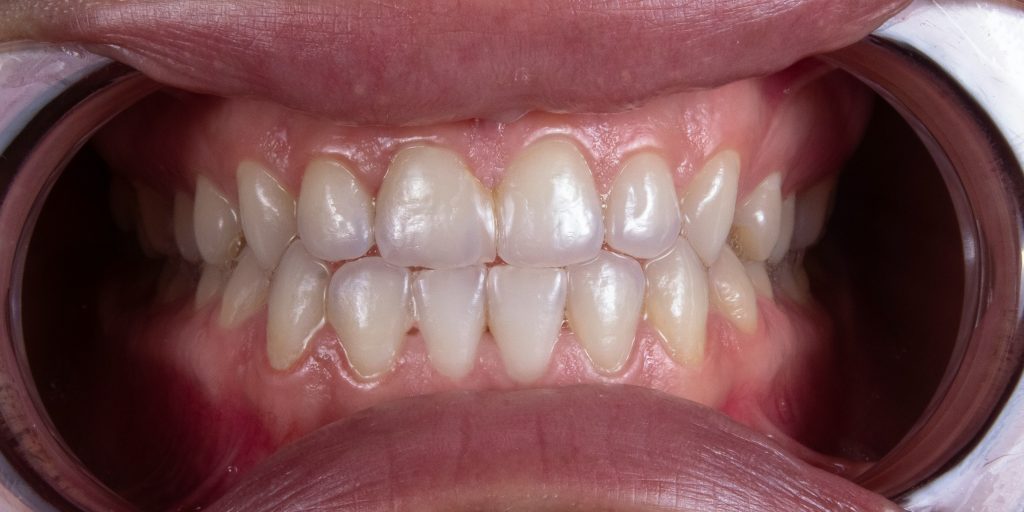 A front view of teeth that have been whitened.